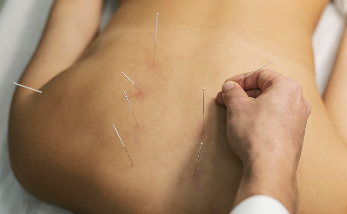Acupuncture for Longevity: A Science-Based Guide to Health Benefits and Practical Applications